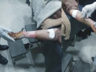 حضرو،  ہیٹر سے کپڑوں کو آگ لگ گئی ،میاں بیوی جھلس گئے